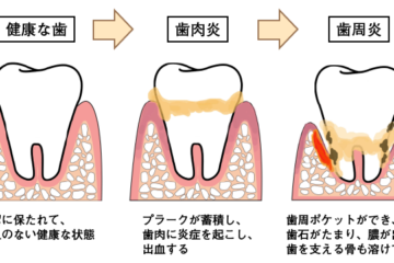 歯周病と虫歯どちらが怖い